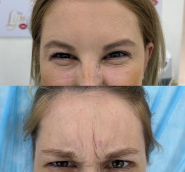 botox San Jose Costa Rica