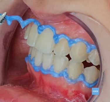 blanqueamiento dental