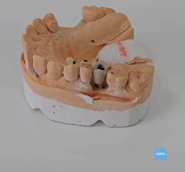 implante dental