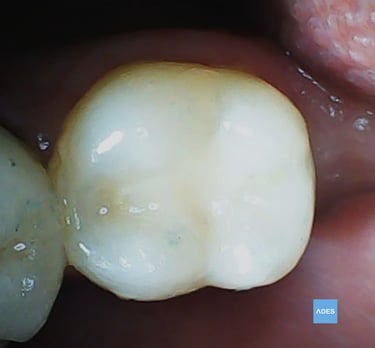 empaste clinica dental badajoz