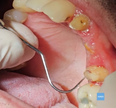 puente dental