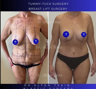 Körperstraffung nach Gewichtsverlust