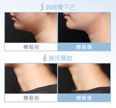 BTL臉部成效見證