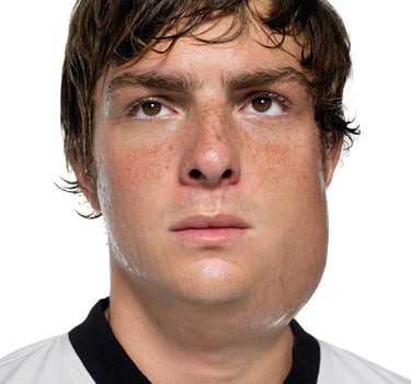 mumps