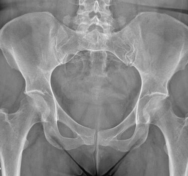 Pelvis Xray