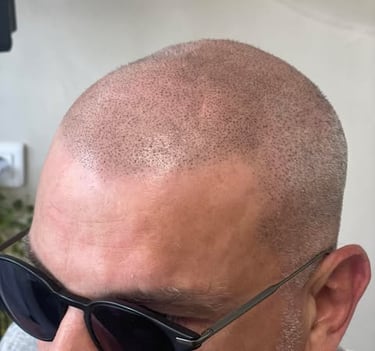 homme tatouage cheveux micropigmentation capillaire chauve