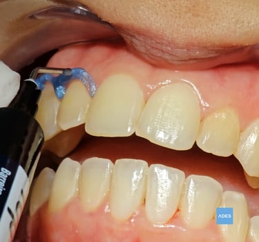 blanqueamiento dental