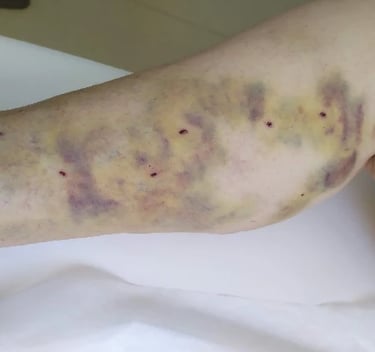a person with a wound wound on their leg