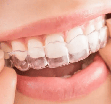 الفرق بين التقويم العادي والشفاف