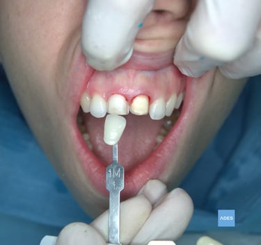 carilla dental clinica dental ades