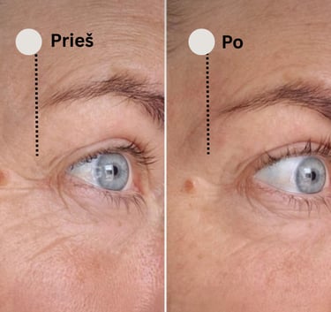 pleistrų nuo raukšlių poveikio pavyzdys ant moters