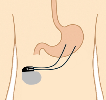 pacemaker gastrique