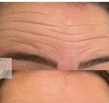 Botox and fillers in Hull 