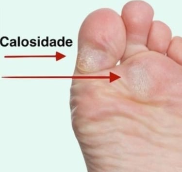 TRATAMENTO CALOS EM BH