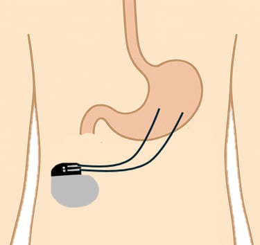pacemaker gastrique