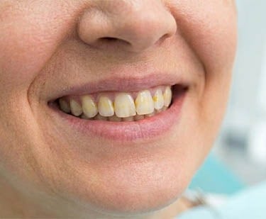 Taches jaune sur les dents hygiene-precision.com