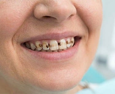 Taches brunes et noires sur les dents hygiene-precision.com