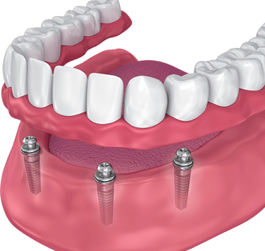 a image showing implant supported denture