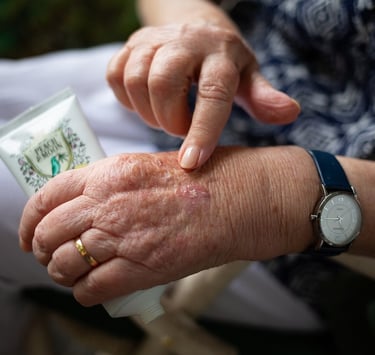 Older woman applying cream on her swollen hand.