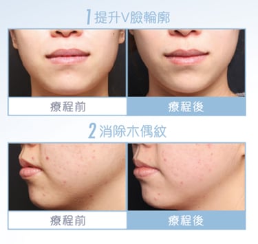 BTL臉部成效見證