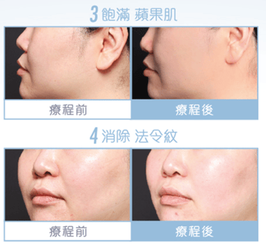 BTL臉部成效見證