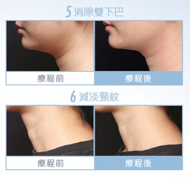 BTL臉部成效見證