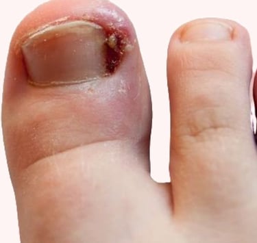 TRATAMENTO UNHA ENCRAVADA EM BH