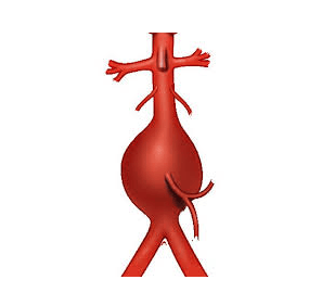vascular ultrasound artery abdominal aorta aneurysm back pain bulge blood symptoms rupture risk factors treatment stent aaa