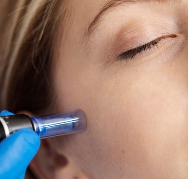 Microneedling mit SkinPen im Aesthetik Atelier Bochum für glattere Haut
