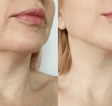 Harmonização do contorno facial com preenchimento de mandíbula na clínica médica e estética em Setúb