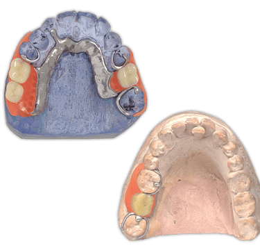 Protesis-Removible-Hibrida-Metal-Flexible-PartialFlex