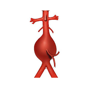 vascular ultrasound artery abdominal aorta aneurysm back pain bulge blood symptoms rupture risk factors treatment stent aaa