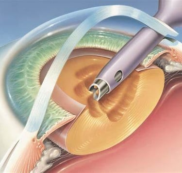 cataract-surgery-hyderabad