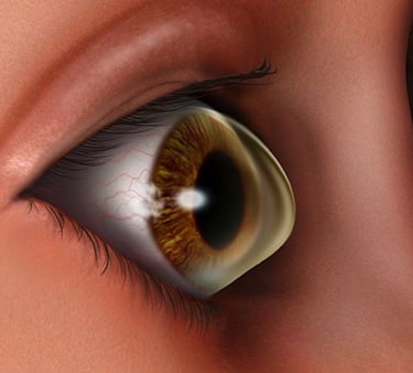 Keratoconus-treatment-near-me