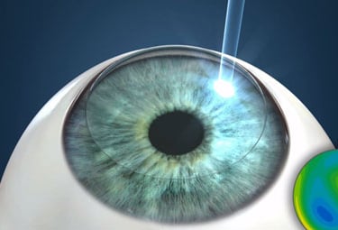 LASIK-Secunderabad-Nexus-Vision