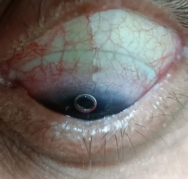 scleral-lens-near-me