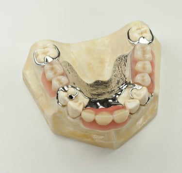 cast partial denture