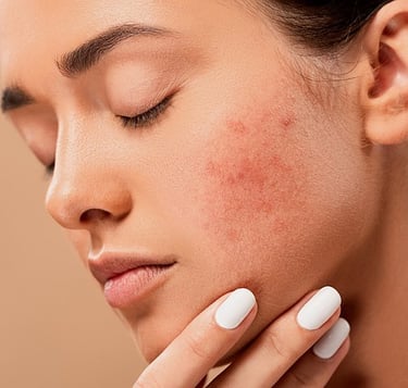 hyaluronic acid may cause redness , skin itching ,bruising.