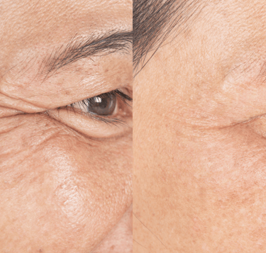 Tratamento com botox para suavizar rugas e linhas de expressão na clínica médica e dentária em Setúb