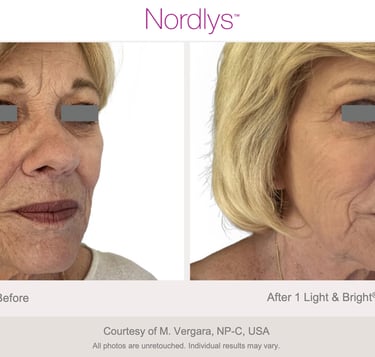 professional skin rejuvenation treatment for brighter and healthier skin in Hamilton clinic