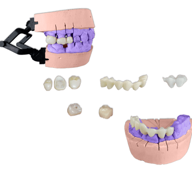 Protesis Fija Estetica Zirconia