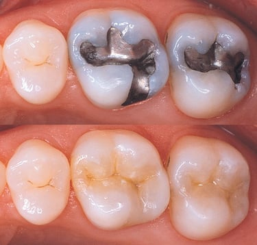 tooth and silver colored fillings