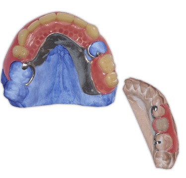 Protesis-Removible-Hibrida-Metal-Flexible-Valplast