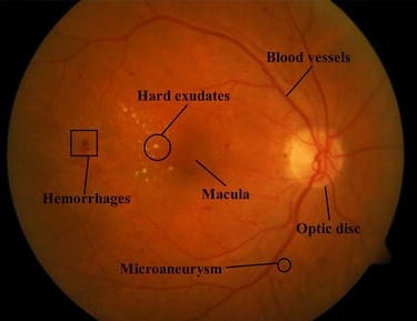 Retinal Diseases Fundus OCT VFA 