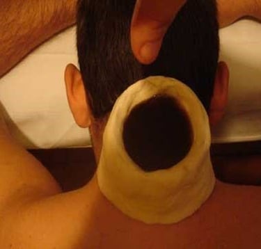 Greeva vasti at HLC Ayurveda nature cure, bengaluru