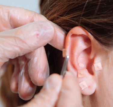 Auriculoterapia