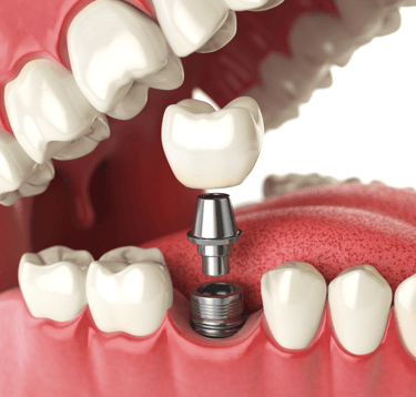 Clínica de implantologia em Setúbal, especialistas em implantes dentários modernos.