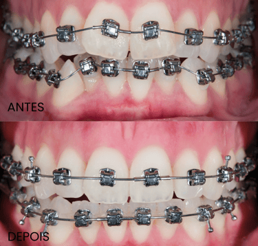 Clínica especializada em ortodontia e aparelhos dentários em Setúbal.