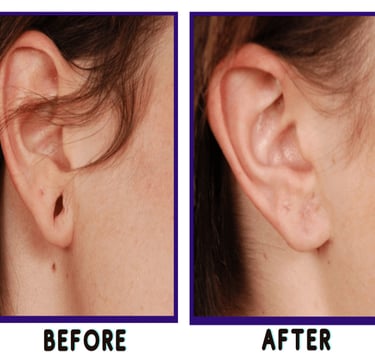 Ear lobe repair in Vadodara: Enhance your beauty with the expertise of the best cosmetic dermatologist