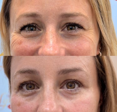 Botox en San José cerca de ti  Estamos ubicados en San José, Costa Rica, Escazu